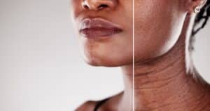 Before and after comparison of a woman’s skin showing visible improvement from microdermabrasion treatment, highlighting smoother texture and anti-aging rejuvenation results