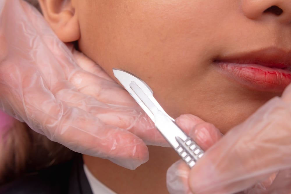 Close-up of a dermaplaning procedure exfoliating the skin by closely shaving the face with a sterile blade.