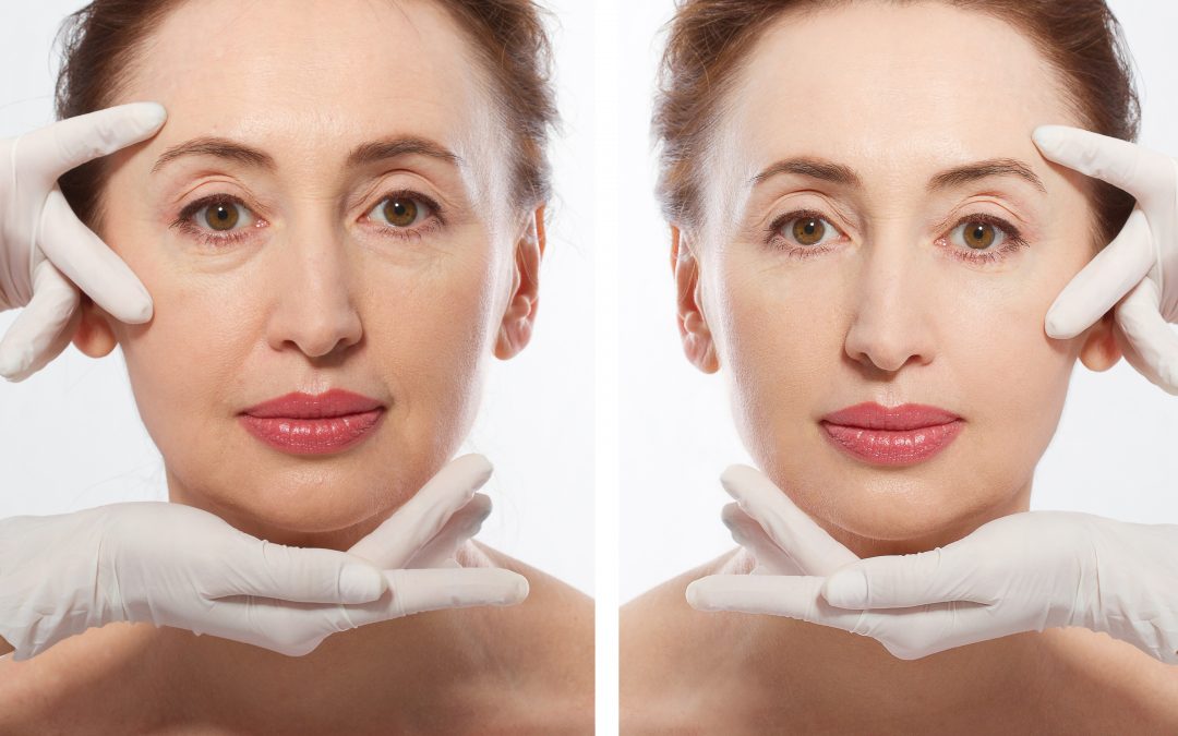 Woman before and after Collagen treatment